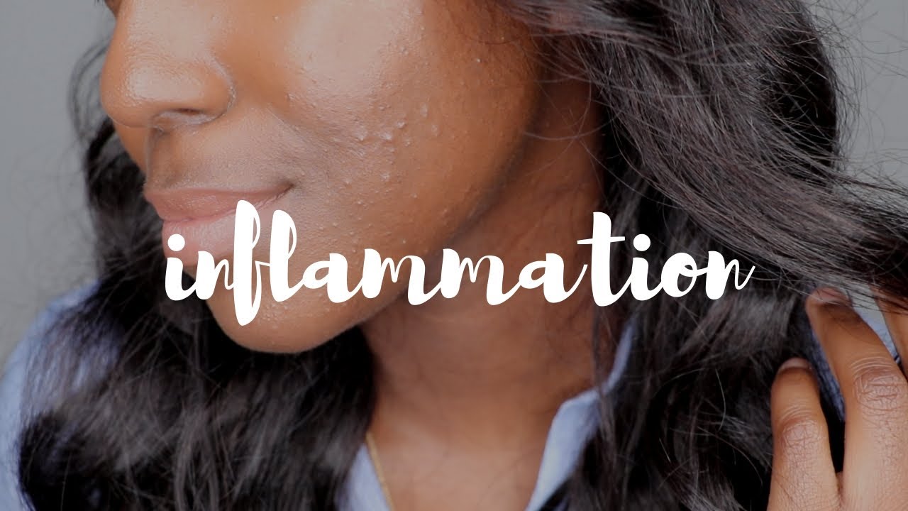 How To Get Rid Of Skin Inflammation [these products saved my skin] | Lakisha Adams