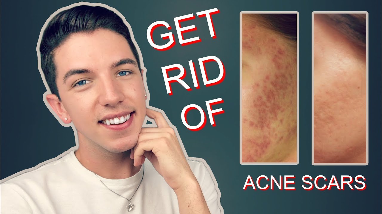 How to Get Rid Rid of Acne Scars Completely!