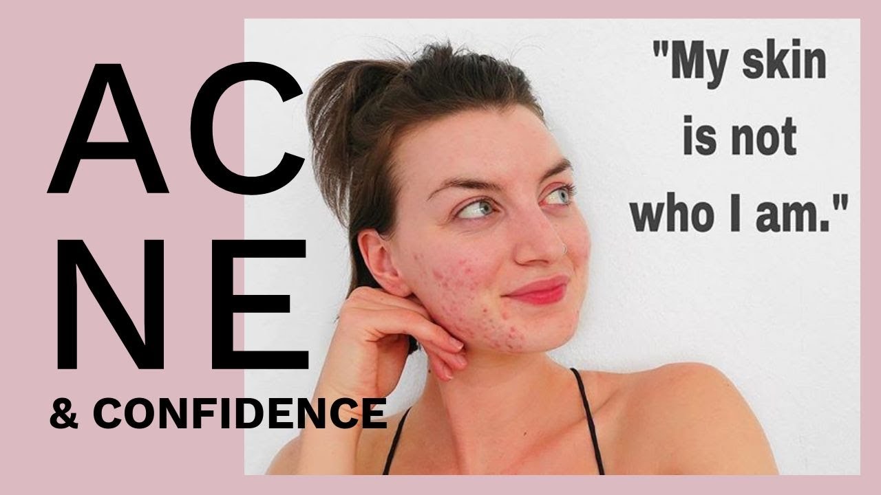 How to Have Confidence with Acne