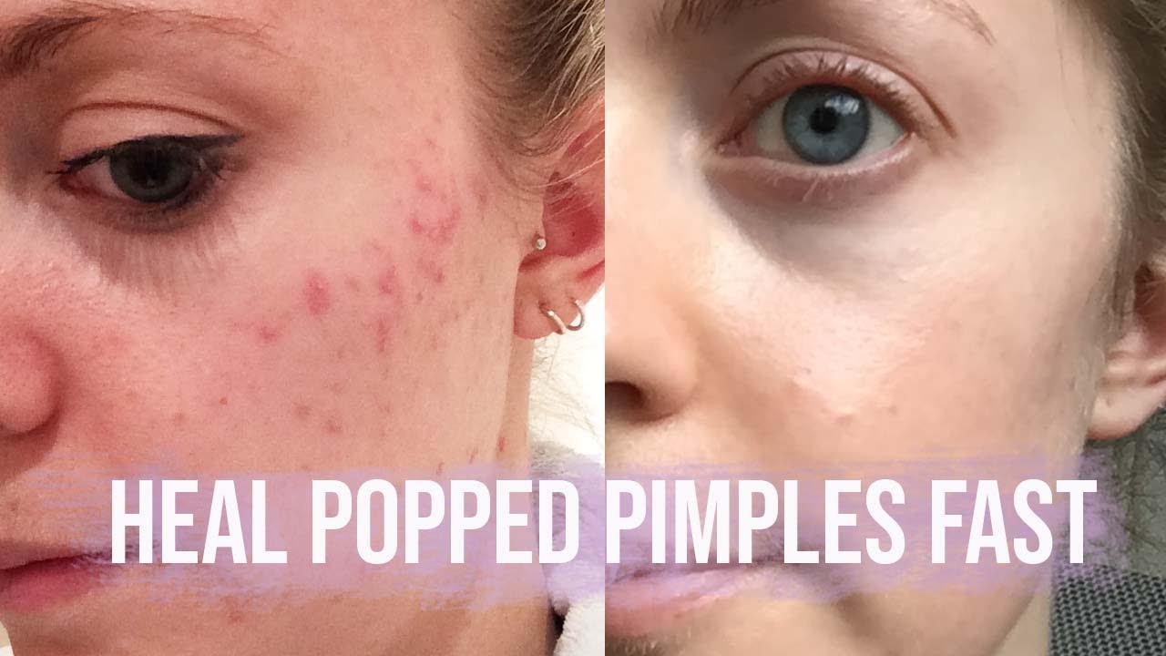 HOW TO HEAL A POPPED PIMPLE FAST