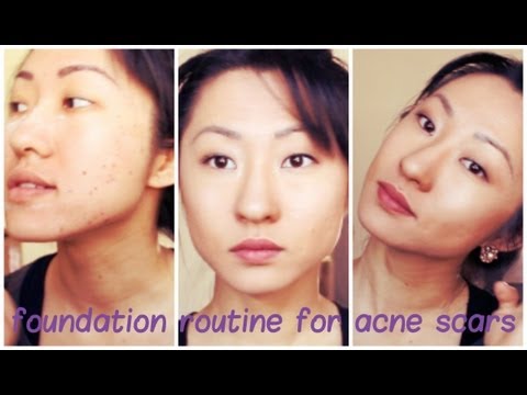 HOW TO HIDE ACNE SCARS | DAISERZ89