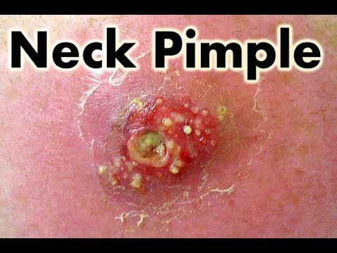 How To Pop Ear Pimple || Liquid In Pimple
