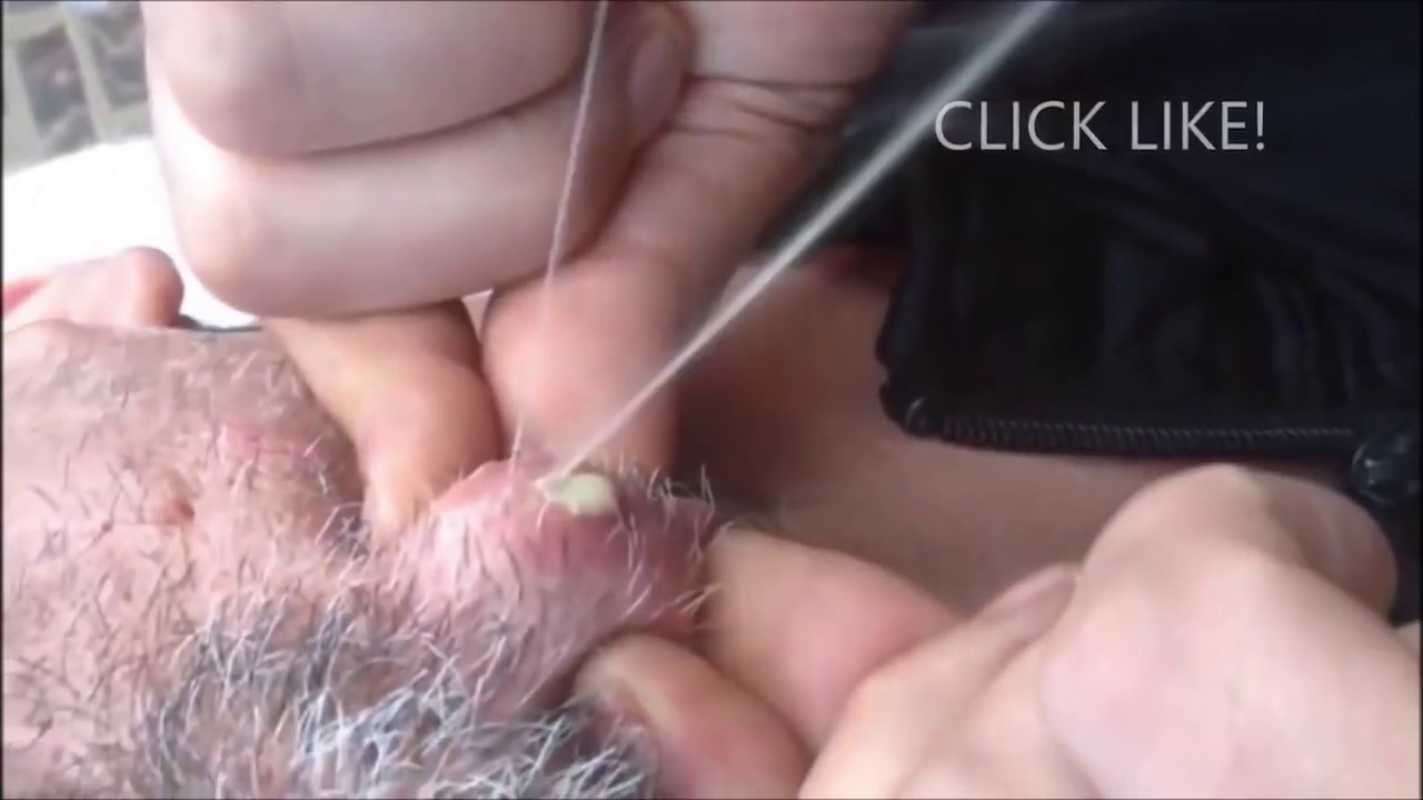 How to Pop Whiteheads & Cysts (Remix)