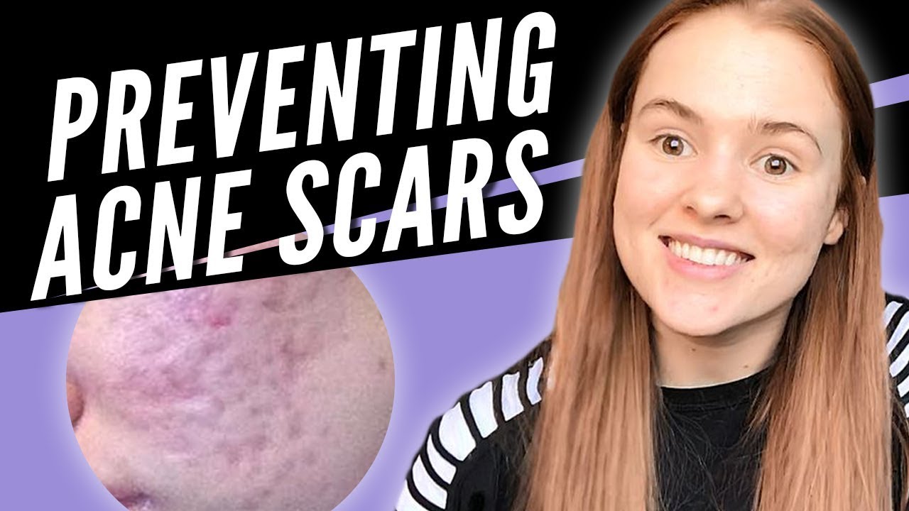 How To Prevent Acne Scars