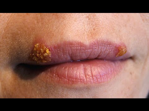 HOW TO PREVENT AND TREAT COLD SORES ASAP! #TMITUESDAYS