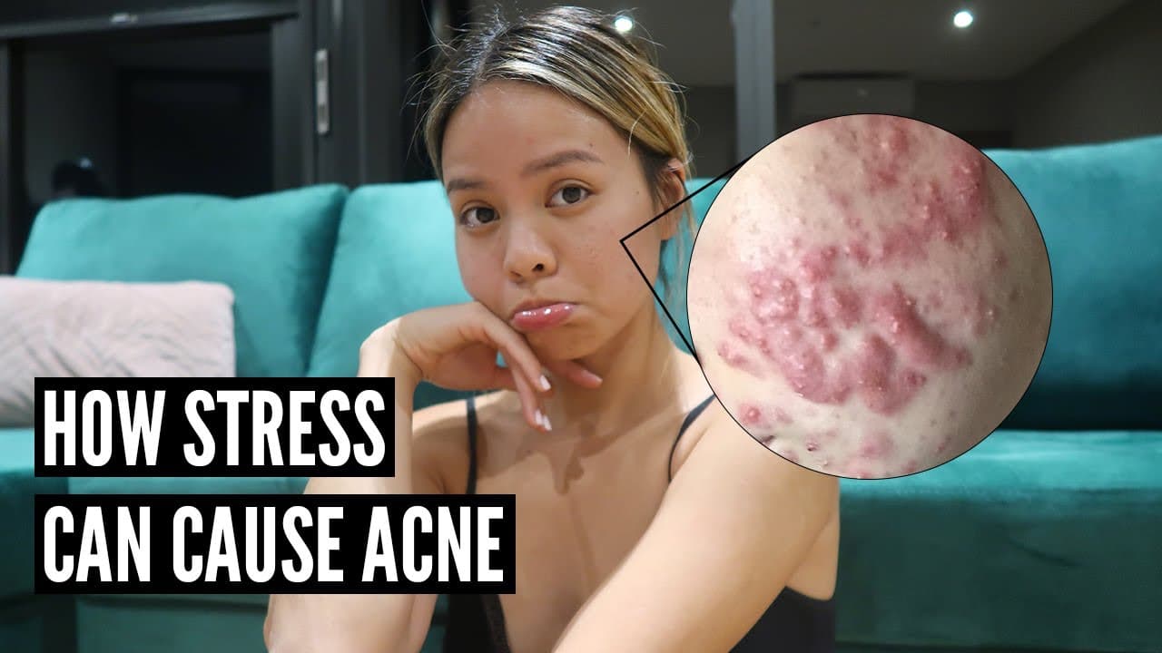 How To Prevent Stress Acne!  Long Term + Short Term Cures