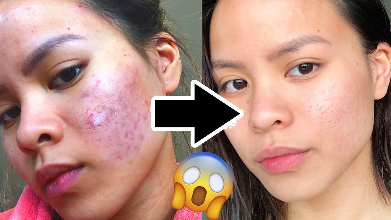How to REALLY Get Rid of Acne Scars FAST!