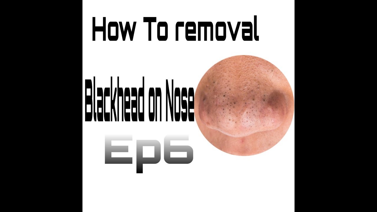 How to removal Blackhead popping #6 Full HD