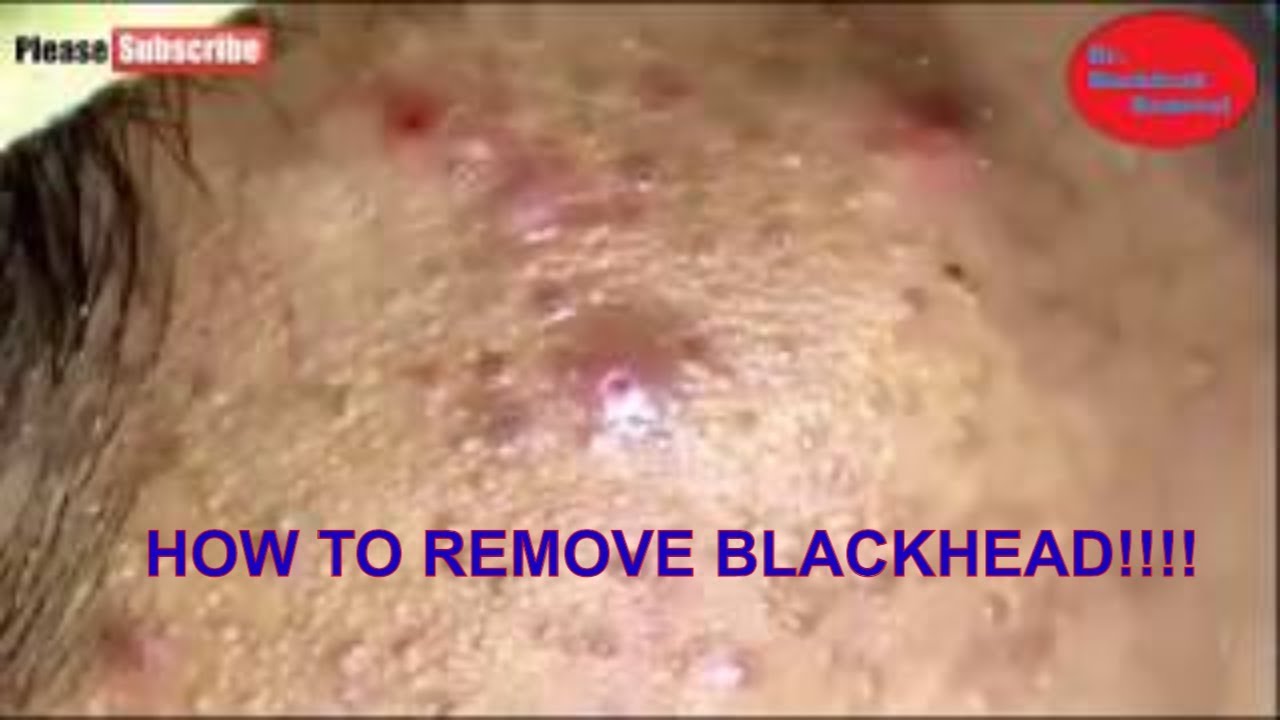 How To Removal Blackheads And How To Get Rid of Blackhead #44
