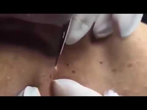how to removal blackheads and whiteheads pimple popping extraction acne scar removal at home