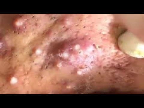 How to removal blackheads on face so relax #6 | Best Pimple Popping Videos 2020