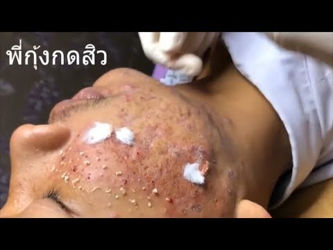 How to Removal Pimple Popping & Blackheads Acne Video – Acne Treatment