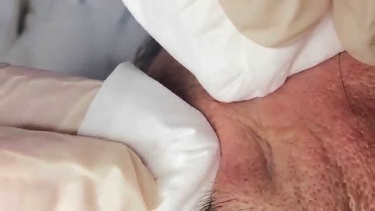 How To Remove a Whitehead (Soft Sebum)