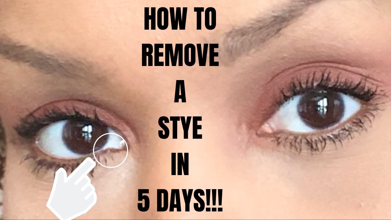 HOW TO | Remove an Eye Stye In 5 DAYS!!!