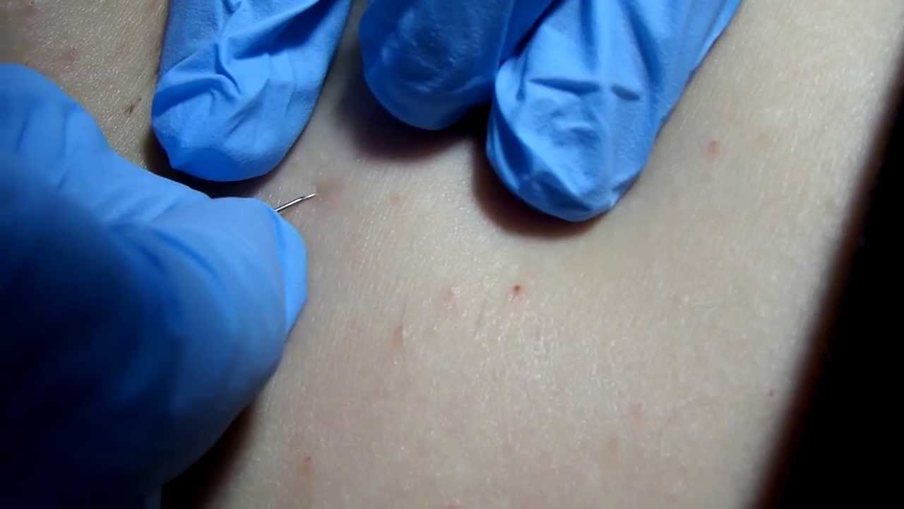 How to remove an ingrown hair.