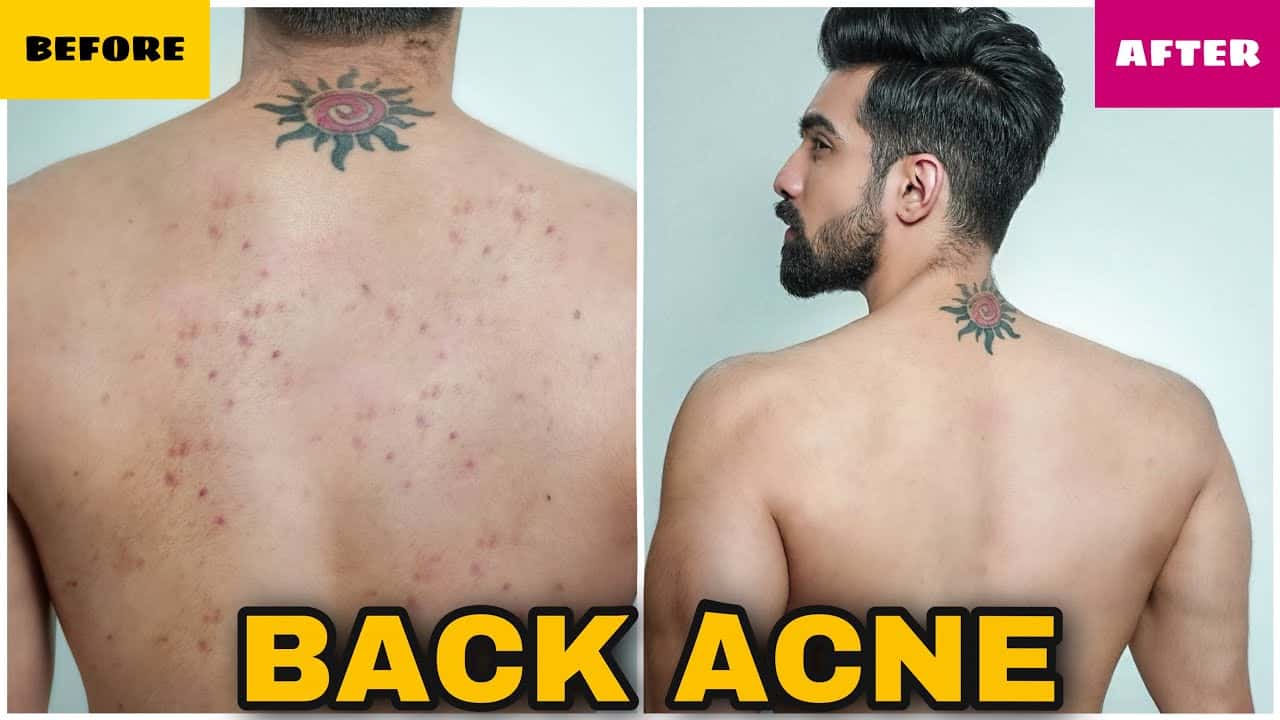 HOW TO REMOVE BACK ACNE FAST|MEN & WOMEN|NATURAL|PIMPLES|BACK ACNE TREATMENT|DARK SPOTS| HINDI