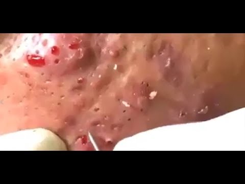 How to remove big blackheads from face – blackhead removal – pimple popping 2019