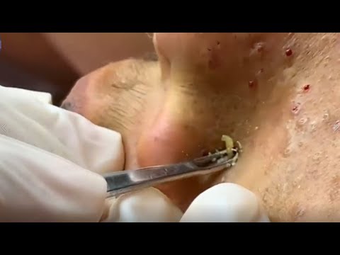 How to remove blackhead on face and Best Pimple Popping Video part 02