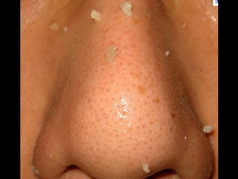 How To Remove Blackheads and Clogged Pores At Home