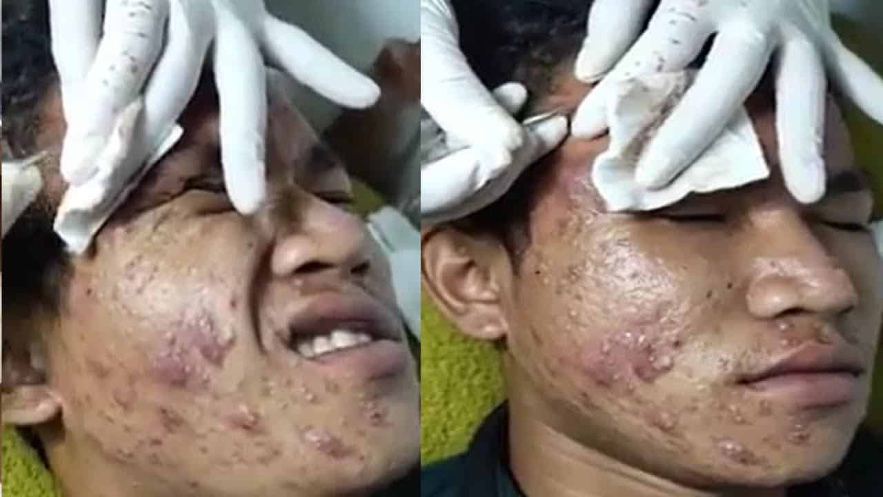 How to remove blackheads  and Cystic Acne, pimples  popping HD
