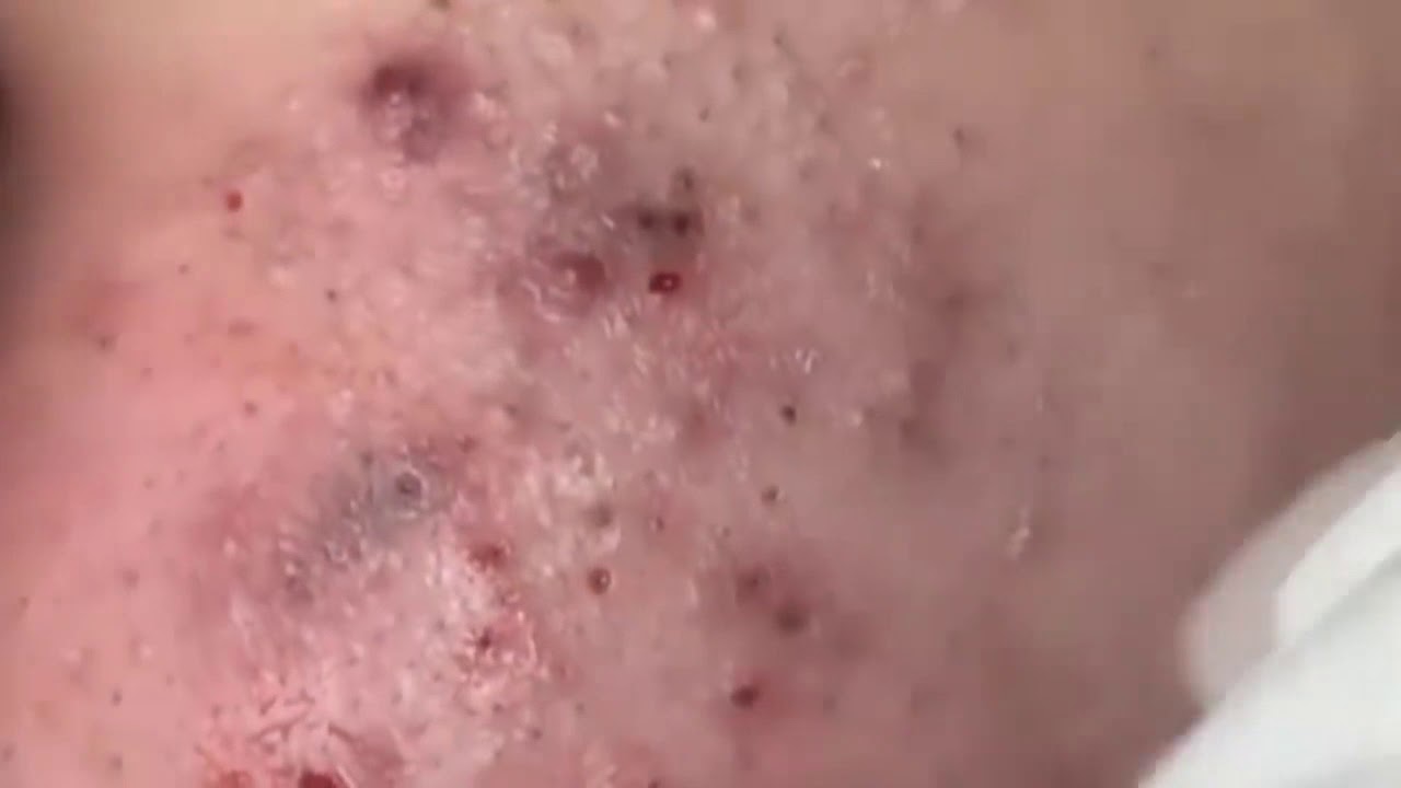 How to remove blackheads and whiteheads on face l Pimple popping 2019 l Part 10