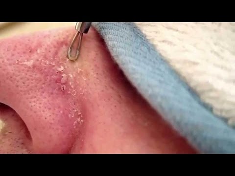 How To Remove Blackheads Using Extractor Tool Surgical Kit