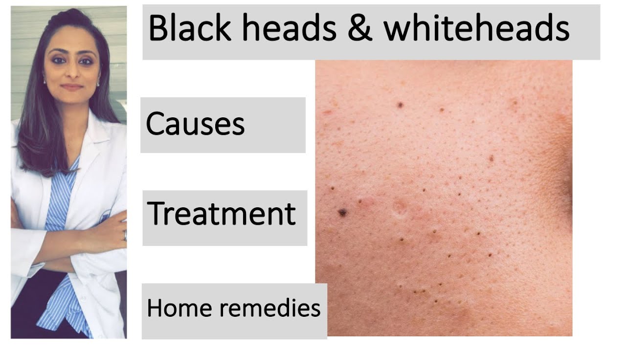 How to remove blackheads & whiteheads| Causes |Treatment | Home remedies| dermatologist