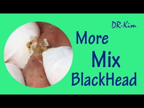 How To Remove Deep Blackheads Removal, Acne Treatment, Popping Pimple Removal