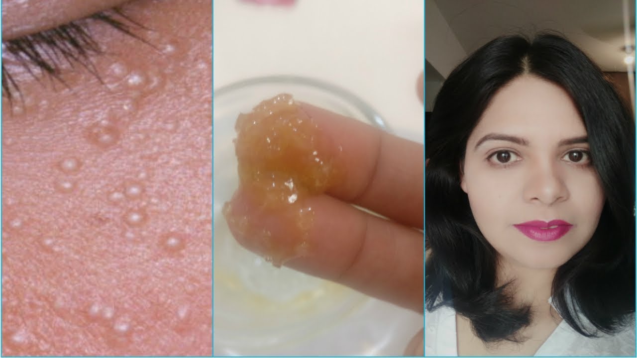 How To Remove Milia Permanently Using Home Remedies|Get Rid of Milia