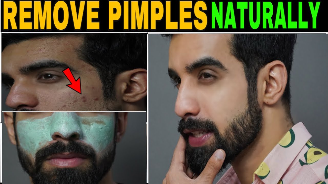 How to Remove PIMPLE NATURALLY FAST? *REALITY* | Acne treatment| TheFormalEdit | Hindi