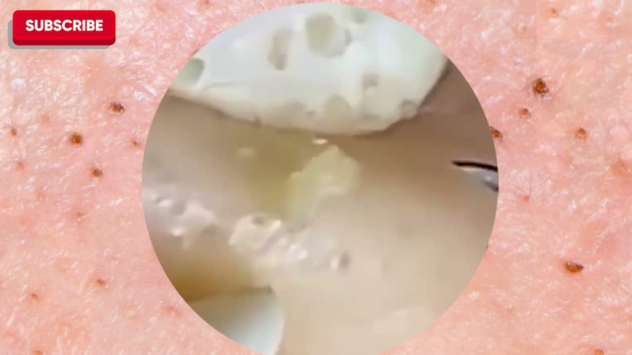 how to Remove Pimple-popping Extraction