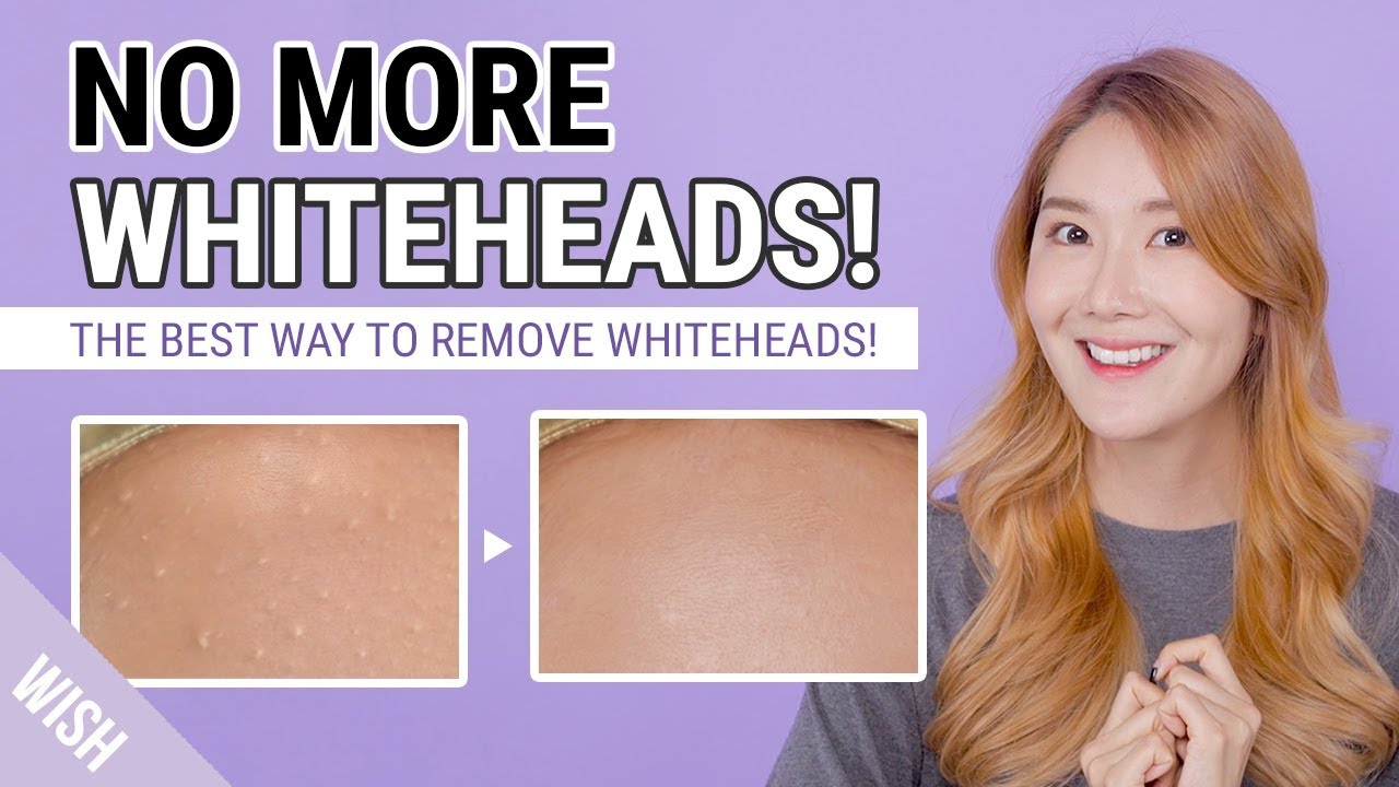 How To Remove Whiteheads, Small Bumps | Whitehead Removal to Prevention Care Routine | Wish,Try,Love