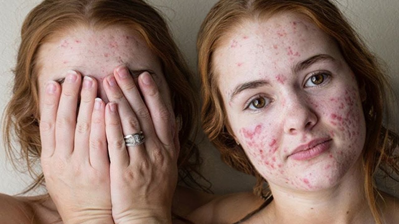 How to Stay Confident with Acne and Acne Scars