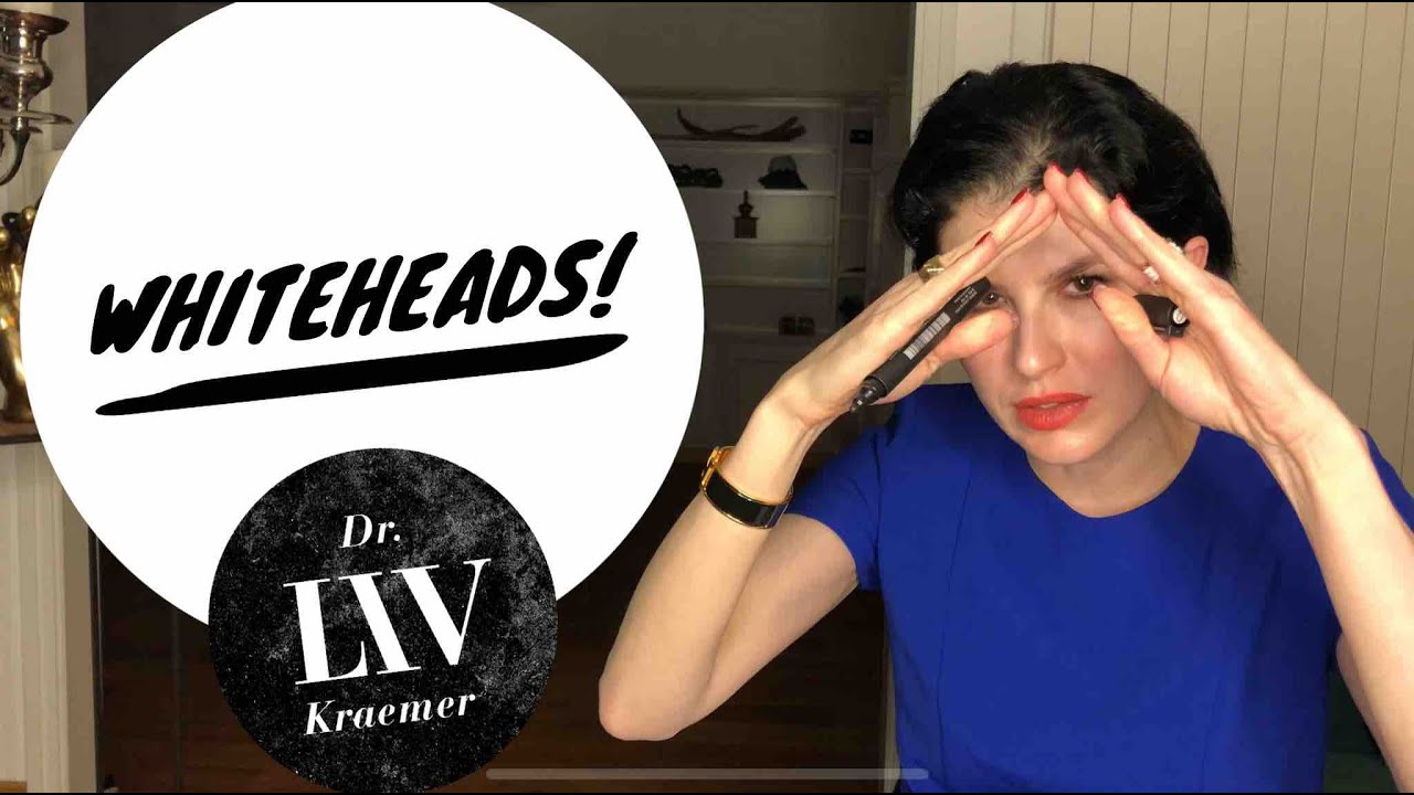 How to stop getting whiteheads longterm – by dermatologist Dr LIV
