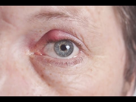How to treat boils and styes
