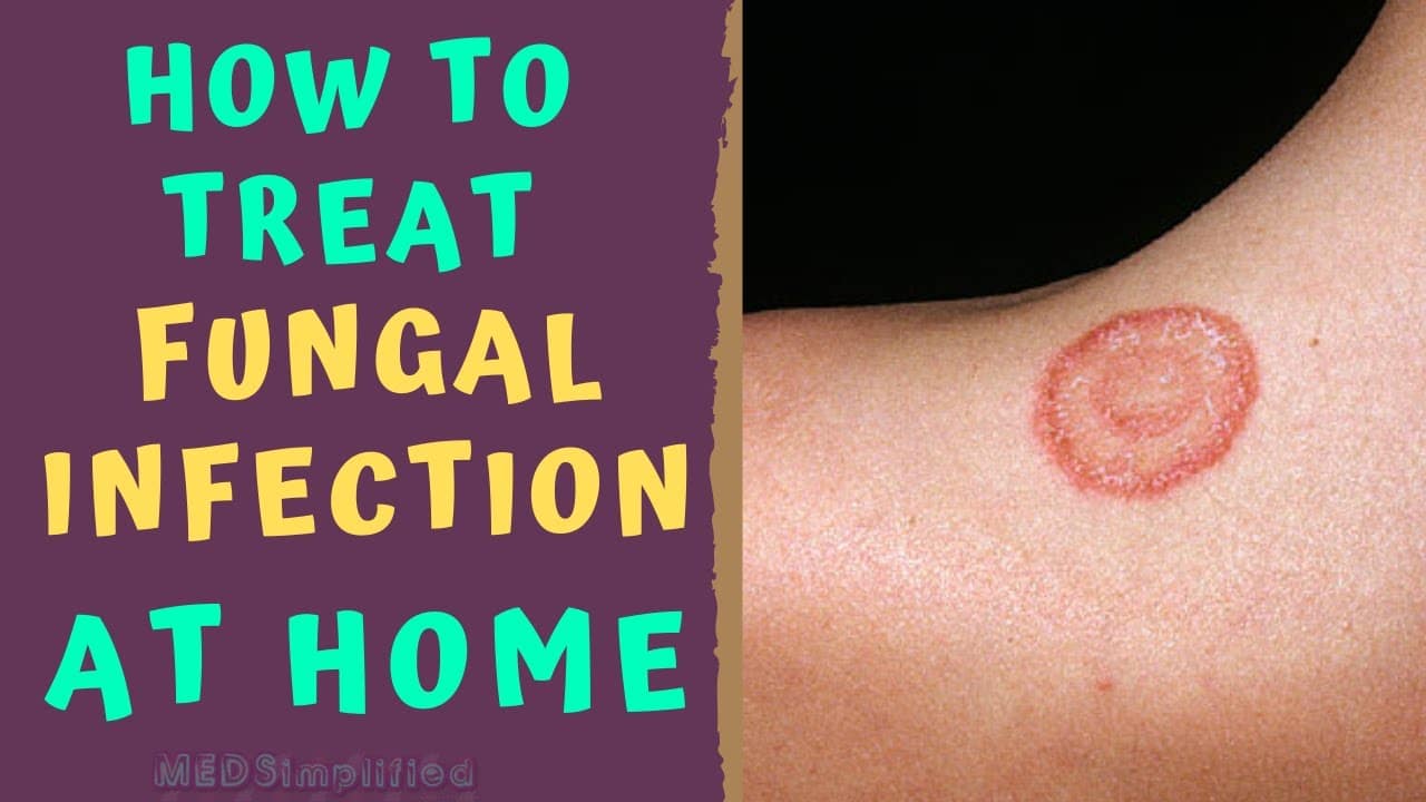 HOW TO TREAT SKIN FUNGAL INFECTION INFECTION AT HOME   TINEA RINGWORM REMEDIES HOW TO CURE