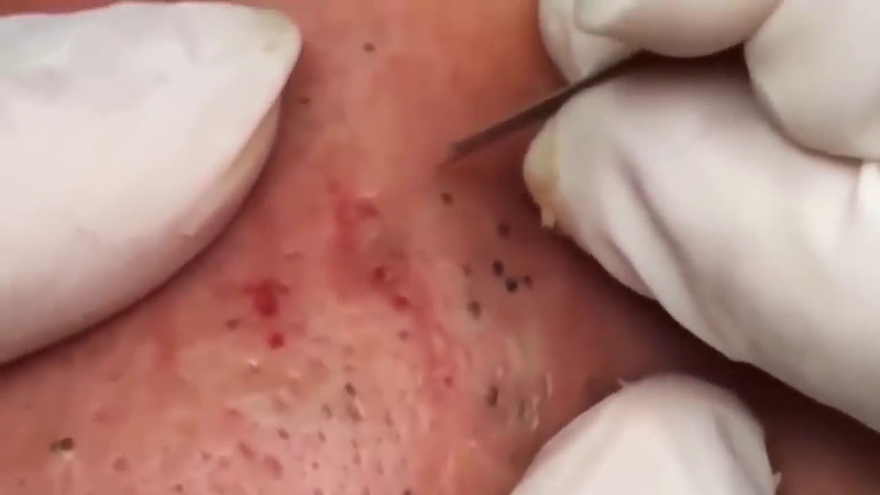 How To Use Blackhead Removal Tool #1
