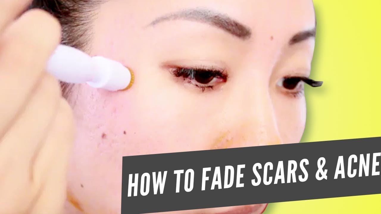 How to Use the Banish Scarring and Active Acne Kit