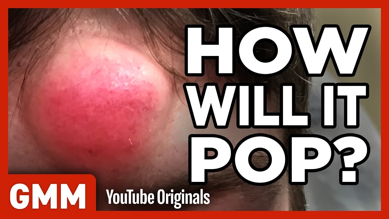 How Will This Pimple Pop? (GAME) ft. Dr. Pimple Popper