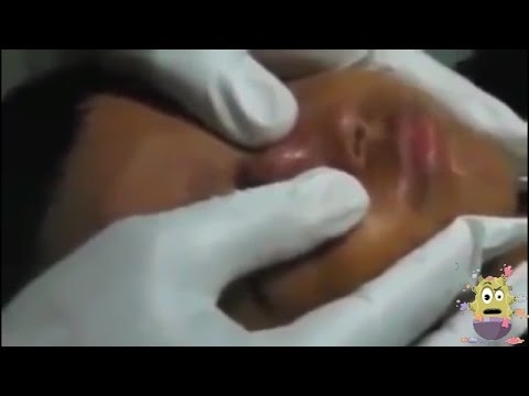 Huge Abscess Cyst Popping On Kid’s Face!!