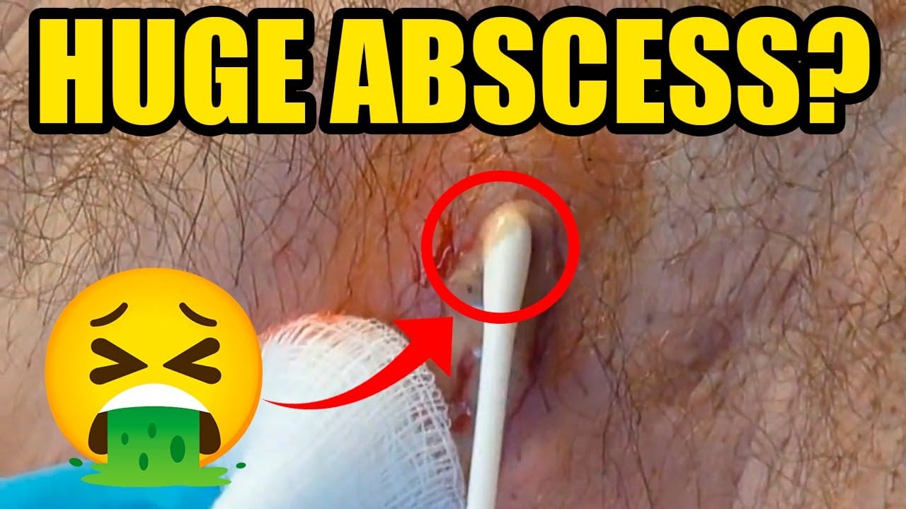HUGE ABSCESS- ..HUGE PLUG REMOVED – BEST ABSCESS  DRAINAGE EVER!!!! STAPH INFECTION POPPED IN ARMPIT