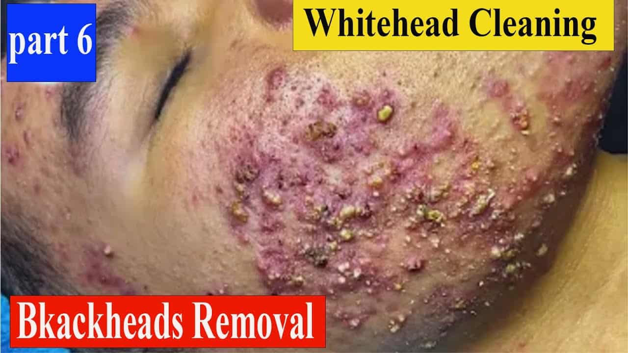.huge acne blackhead extractions, pimple popper blackheads & whitehead removal