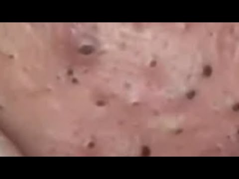 Huge Acne Pimples Blackheads Popping Up Satisfying with Oddly Calm Music Part One