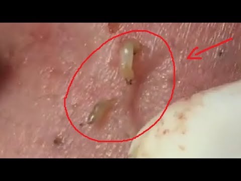 Huge Acne Pimples Blackheads Popping Up Satisfying with Oddly Calm Music Part Two