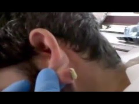 Huge Acne Popping On Neck Compilation