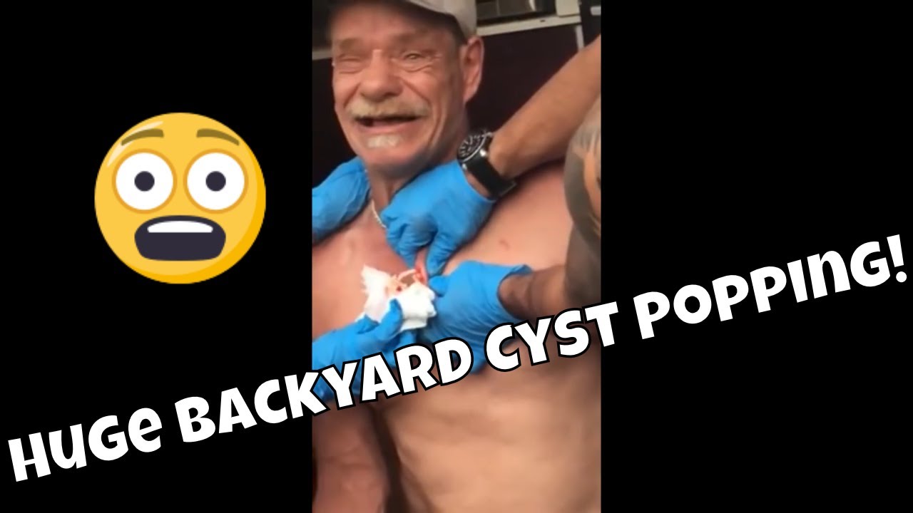 Huge Backyard Cyst Popping! – Original [1080p]