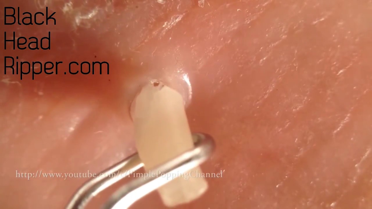 Huge Blackhead Removal and Blackhead Extraction-Best Product