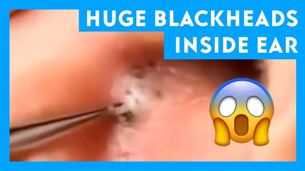 Huge Blackheads Inside Ear || Cyst and Blackheads