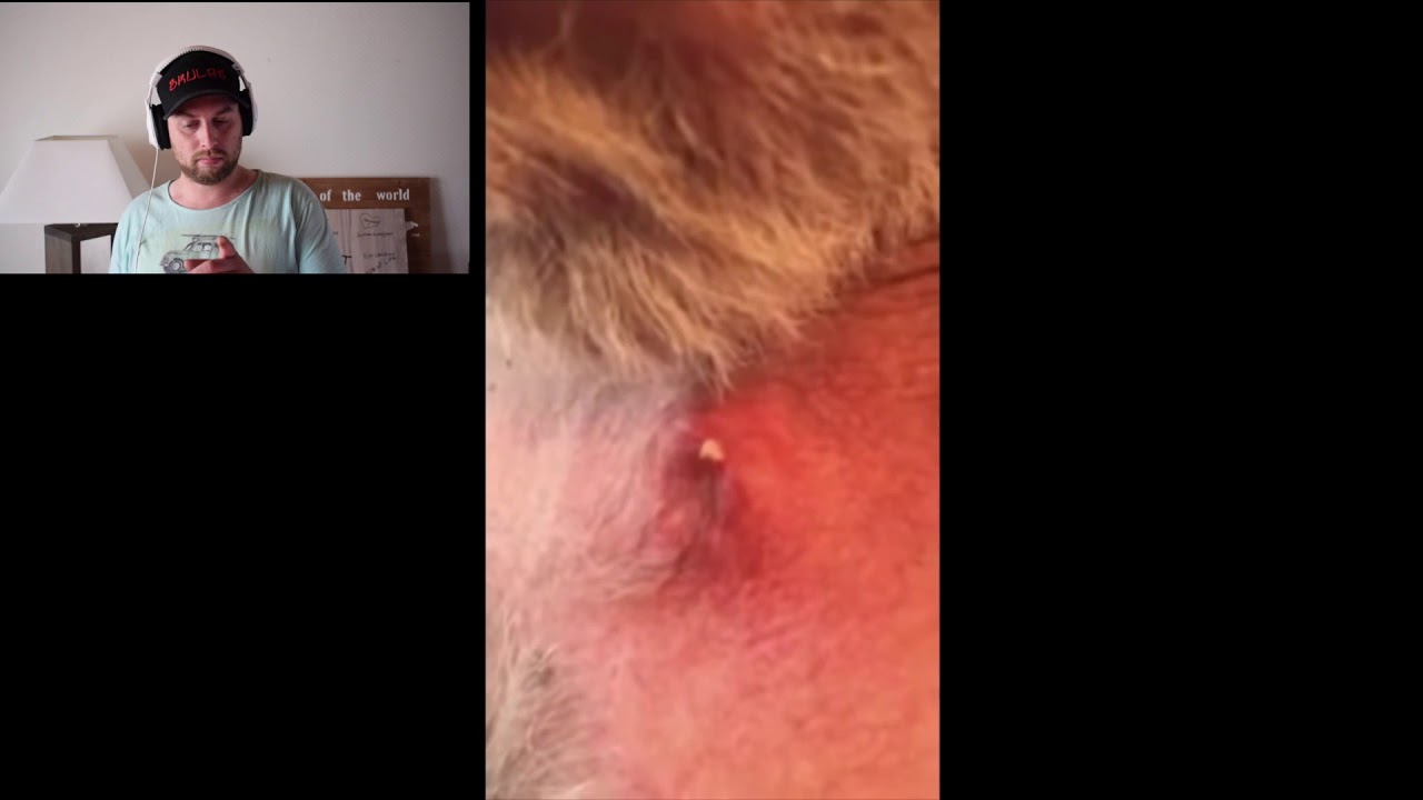 huge cyst explosion on the chest of this man !