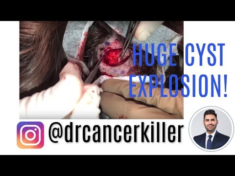 HUGE CYST EXPLOSION with Knife